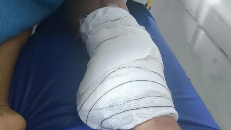 Diarista tem perna amputada após acidente e família busca motorista