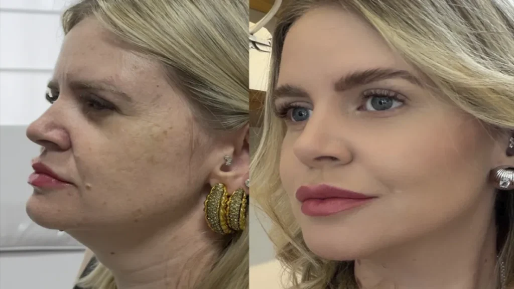 Estética regenerativa: o novo luxo vai além dos preenchedores