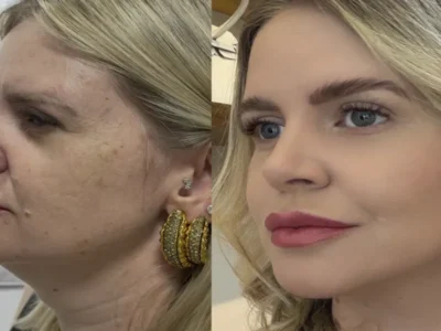 Estética regenerativa: o novo luxo vai além dos preenchedores